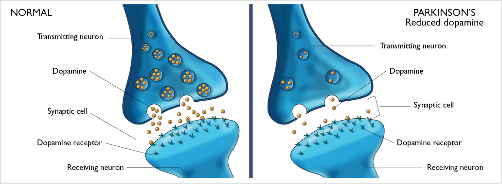 Ilustração de neurônios afetados pelo Mal de Parkinson numa comparação entre neurotransmissores normais e neurotransmissores afetados pela doença.