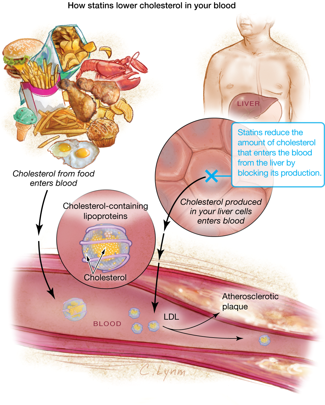 Ilustração do mecanismo de ação das estatinas com um grupo de alimentos composto por batatas fritas, hamburgueres, ovos fritos e coxas de frango no canto superior esquerdo, seguida pela representação de artérias no corpo humano que contém colesterol.
