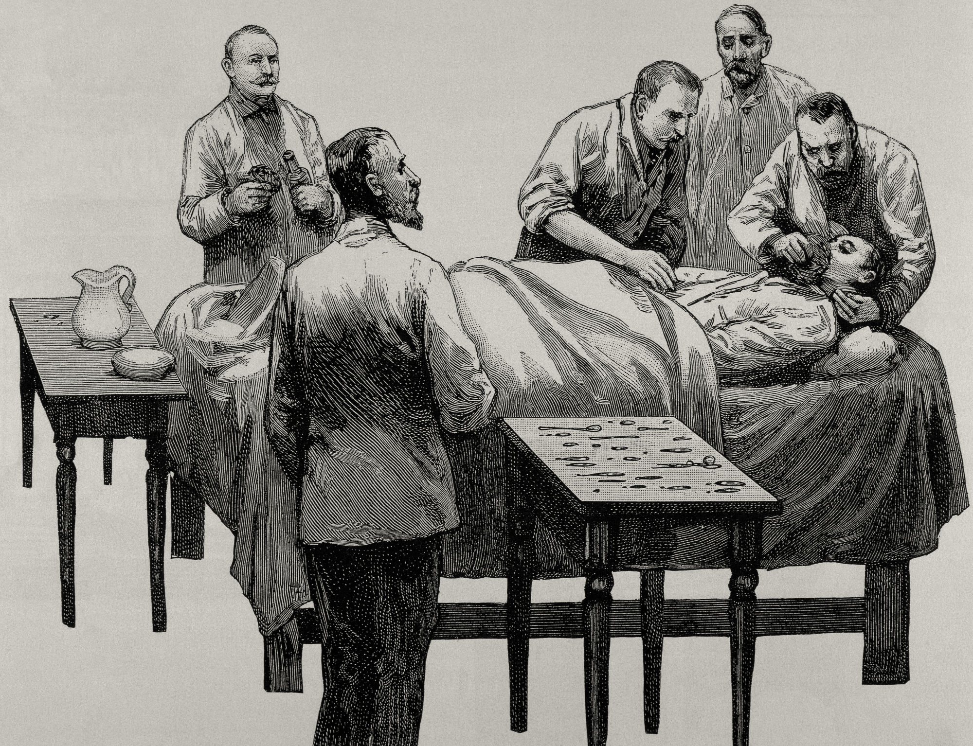 Ilustração em preto e branco, do século 19, de um homem segurando a cabeça de uma pessoa deitada em uma cama, enquanto a outra mão coloca um inalador cobrindo o nariz e a boca do paciente. Ao redor deles, há outros quatro homens e duas mesas de apoio.