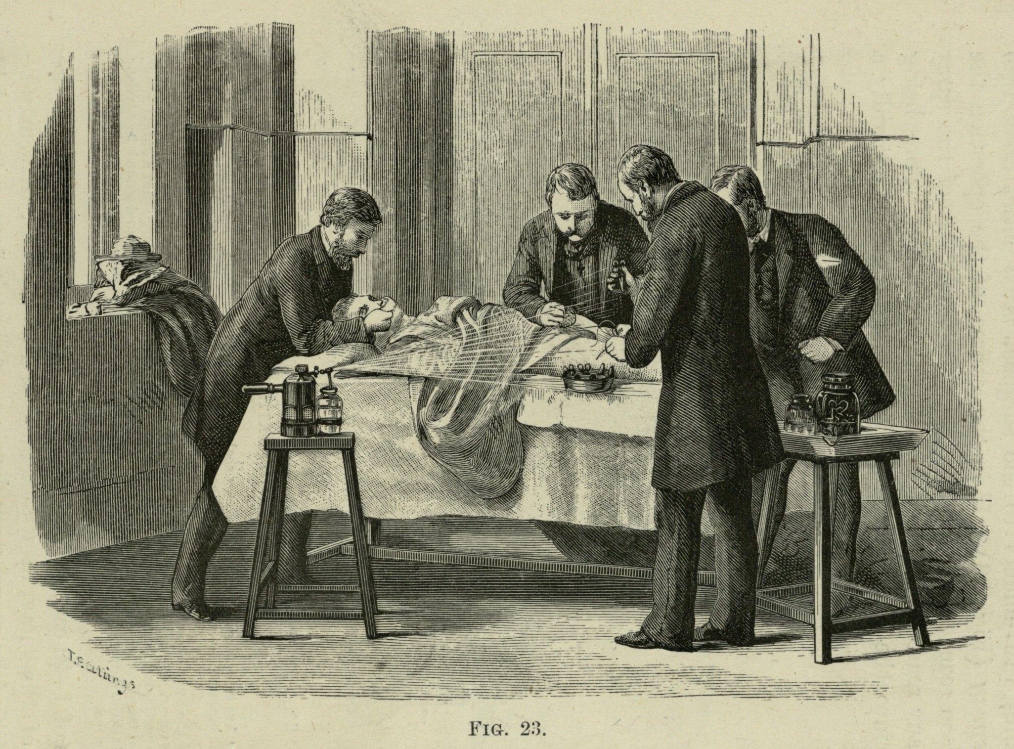 Ilustração em preto e branco de quatro homens, em pé, fazendo uma cirurgia em um paciente deitado em uma cama.
